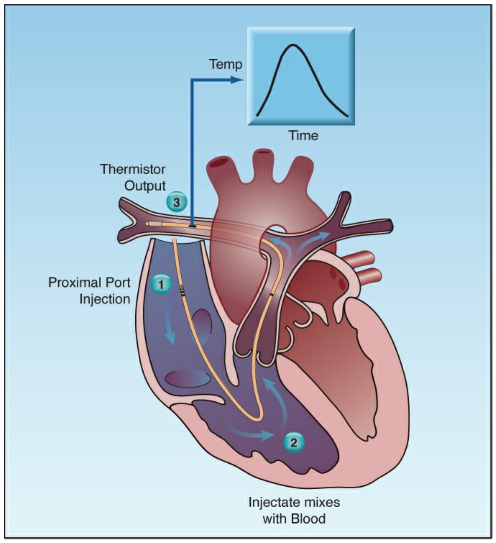 Sơ đồ phương pháp pha loãng nhiệt đo cung lượng tim qua catheter động mạch phổi.