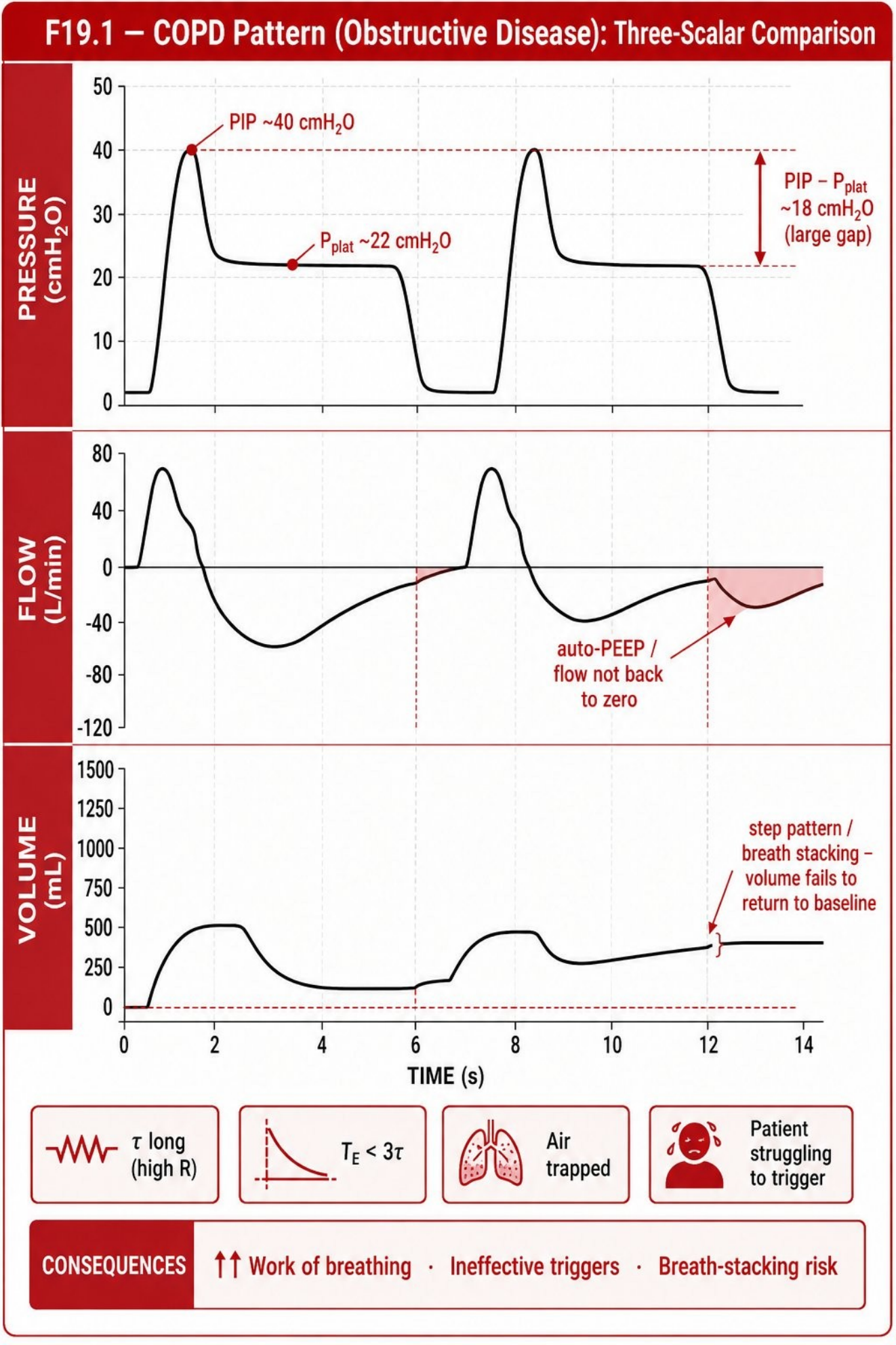 Hình MVG-F19-01. Mẫu đồ họa tắc nghẽn điển hình ở COPD. Nguồn: Mastering Ventilator Graphics, trang PDF 108.