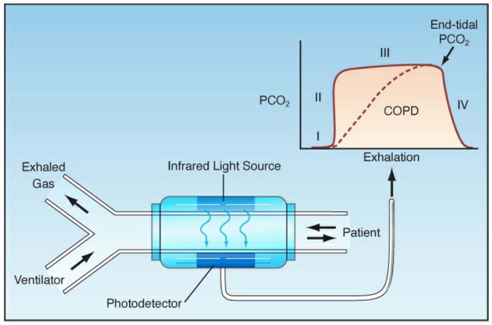 Nguyên lý capnography hồng ngoại trong thở máy